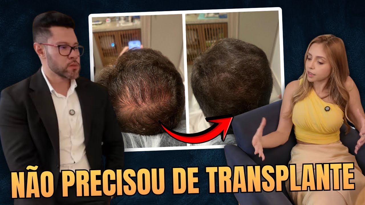 ELE QUERIA TRANSPLANTE DE CABELO… MAS O RESULTADO EM 3 MESES SURPREENDEU