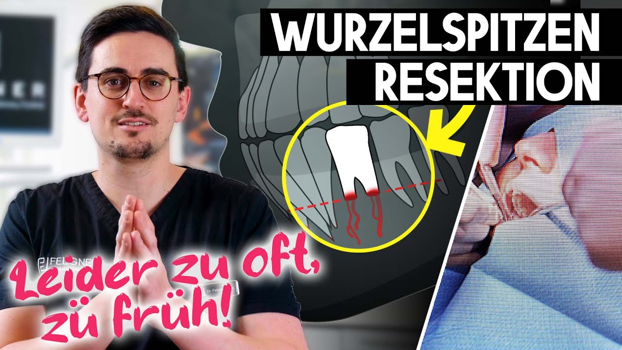 Wurzelspitzenresektion | Wurzelspitzen kappen. Bitte (noch) nicht!