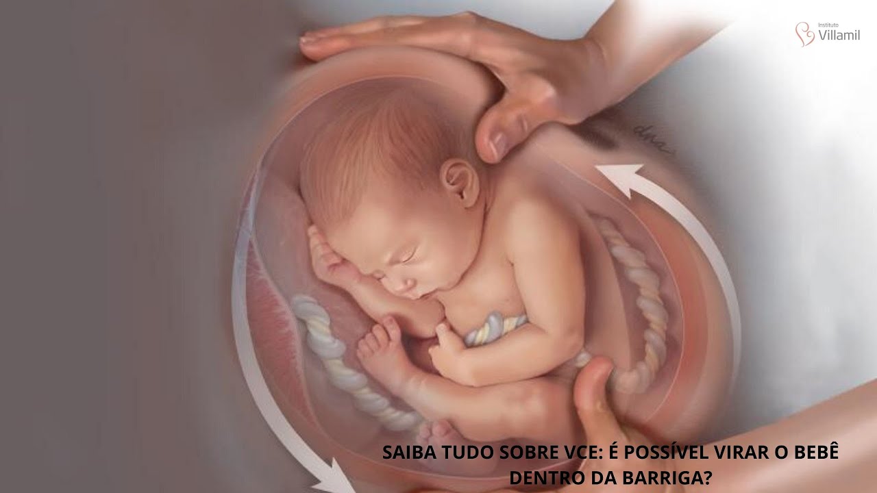 Versão Cefálica Externa - VCE - Como virar o bebê na Barriga da mãe
