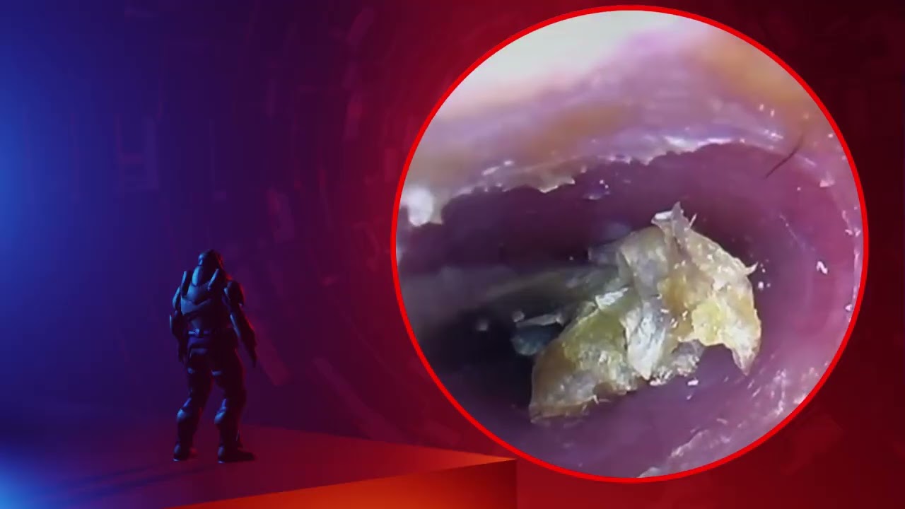 The Truth About earwax Will Shock You. How to remove earwax from ear, earwax extractions
