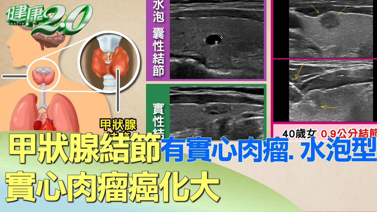 甲狀腺結節有實心肉瘤.水泡型 實心肉瘤癌化大 健康2.0