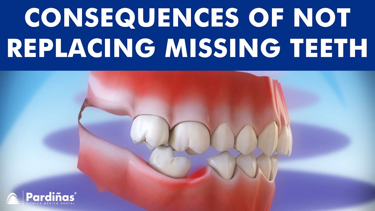 Consequences of not replacing missing teeth &copy;