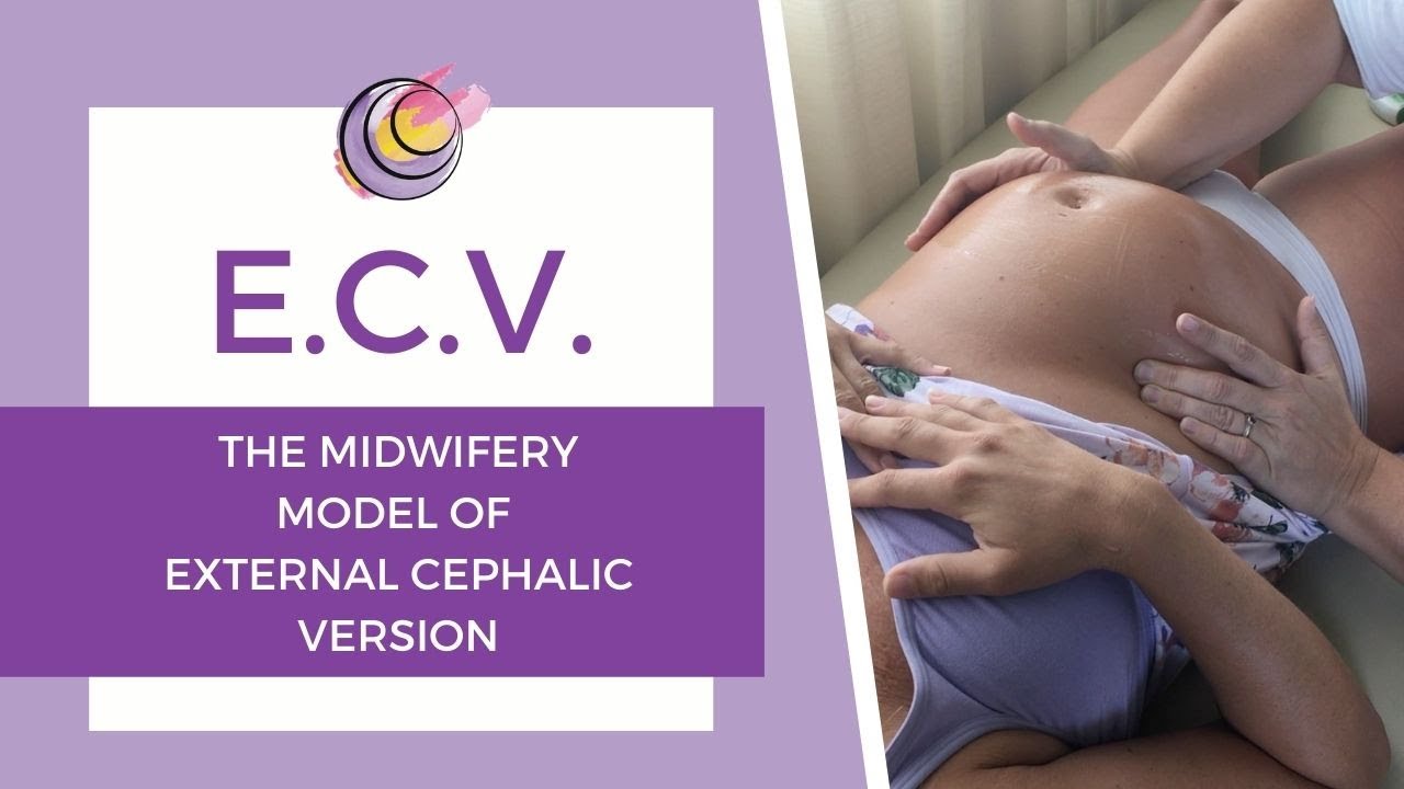 Hands On Example of The Midwifery Model Of External Cephalic Version