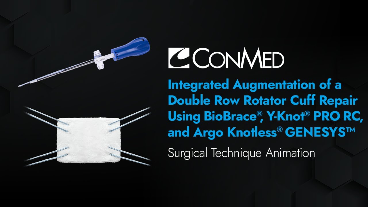 Аугментация двухрядной RCR с использованием BioBrace®, Y-Knot® PRO RC и Argo Knotless® GENESYS™ -...