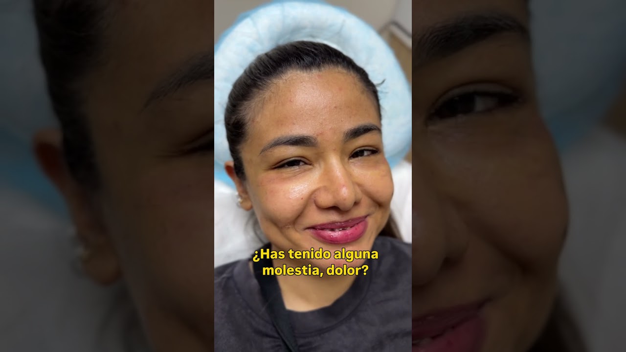 Blefaroplastia inferior despu&eacute;s de 10 d&iacute;as #belleza #ojos #blefaroplastia #parpados