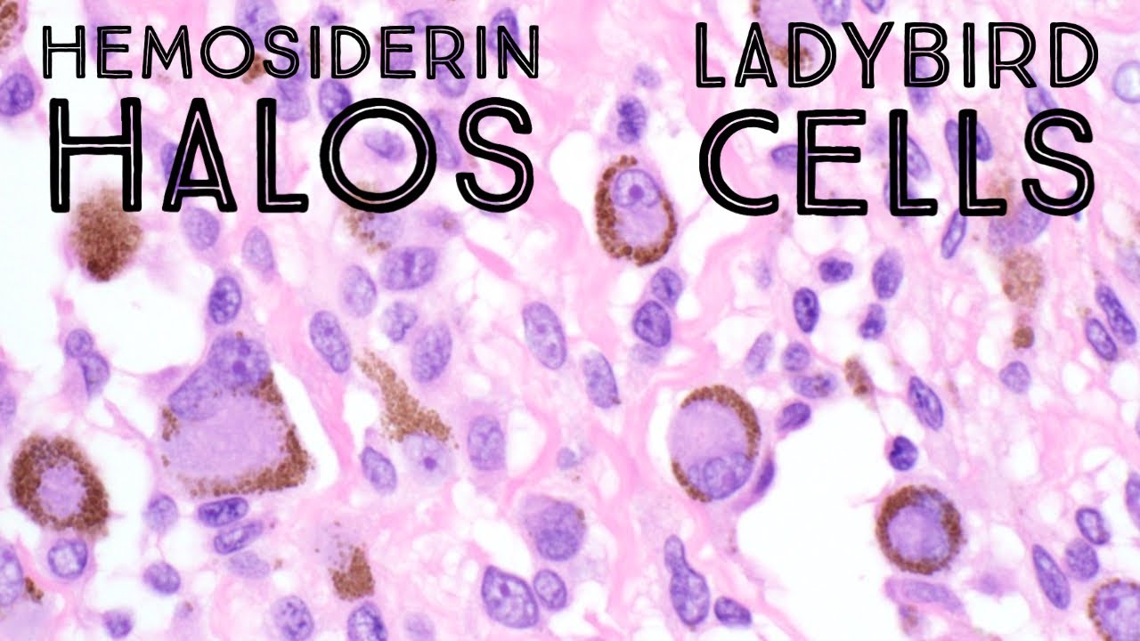 Hemosiderin Halos / Ladybird Cells in Giant Cell Tumor of Tendon Sheath (pathology dermpath)