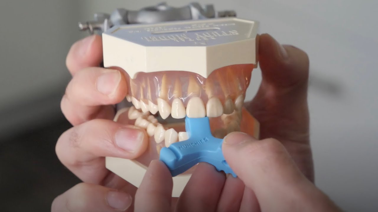 SPEED UP INVISALIGN WITH THIS TRICK!