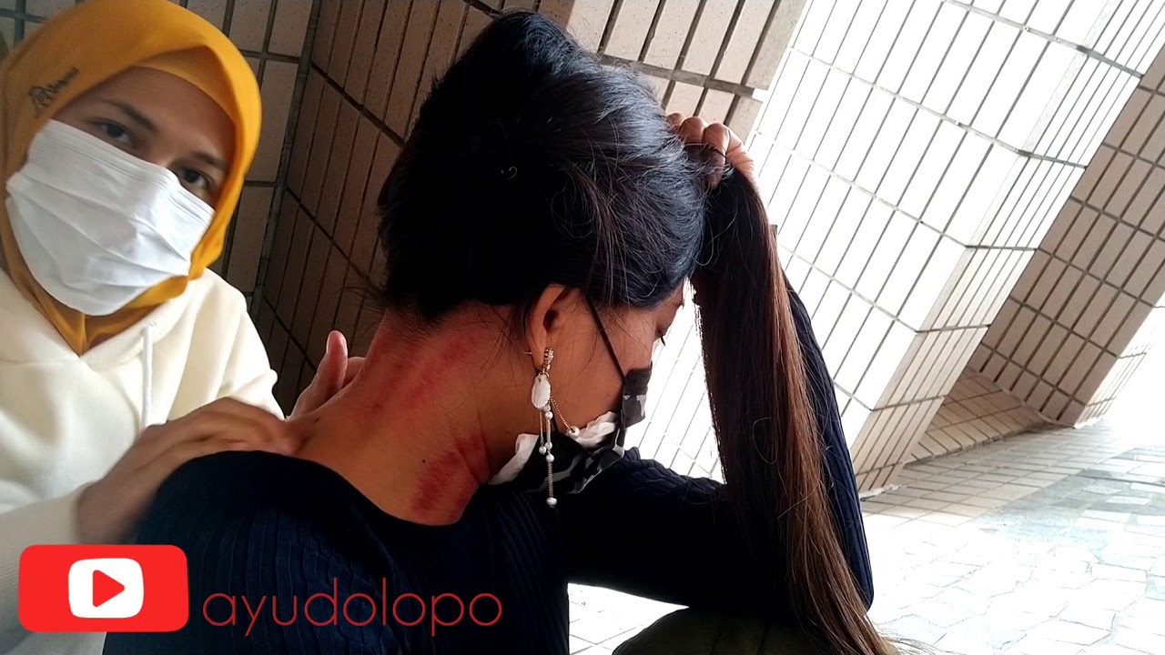 kerokan melingkar sampai gosong karena sakit tengorokan