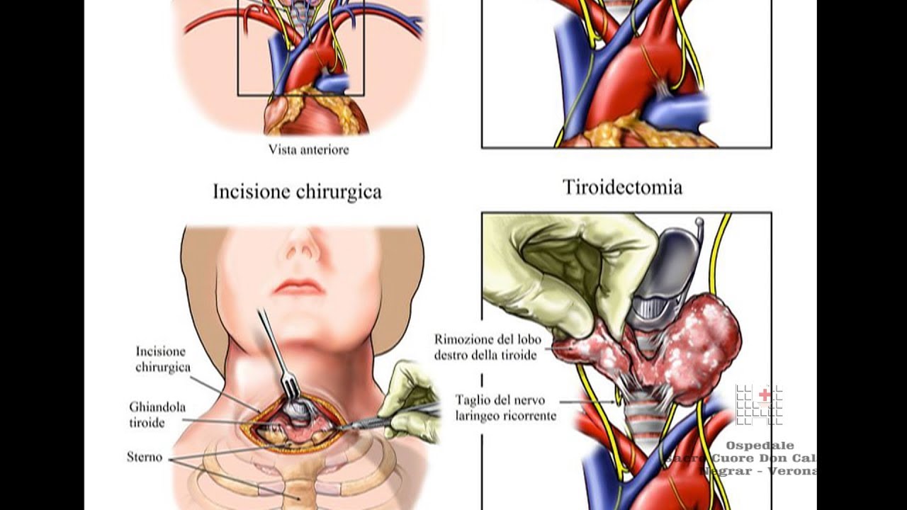 La chirurgia della tiroide