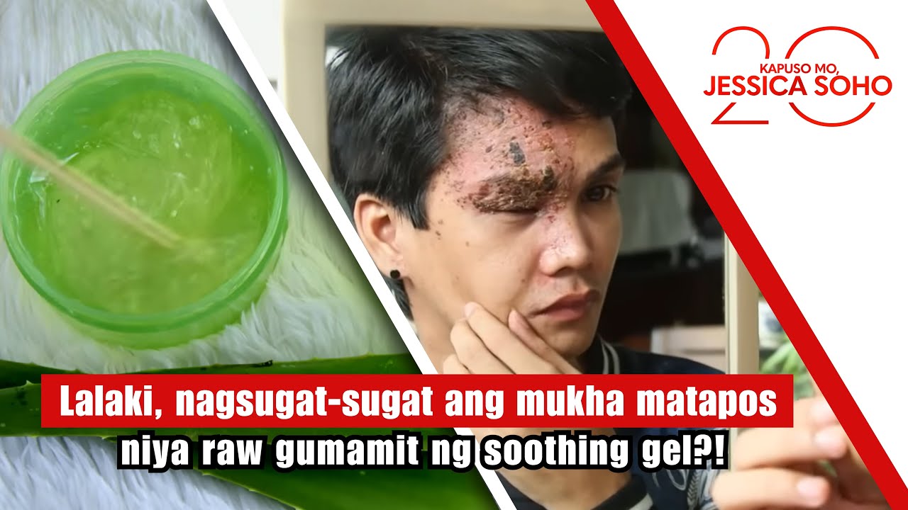 Lalaki, nagsugat-sugat ang mukha matapos niya raw gumamit ng soothing gel? | Kapuso Mo, Jessica Soho