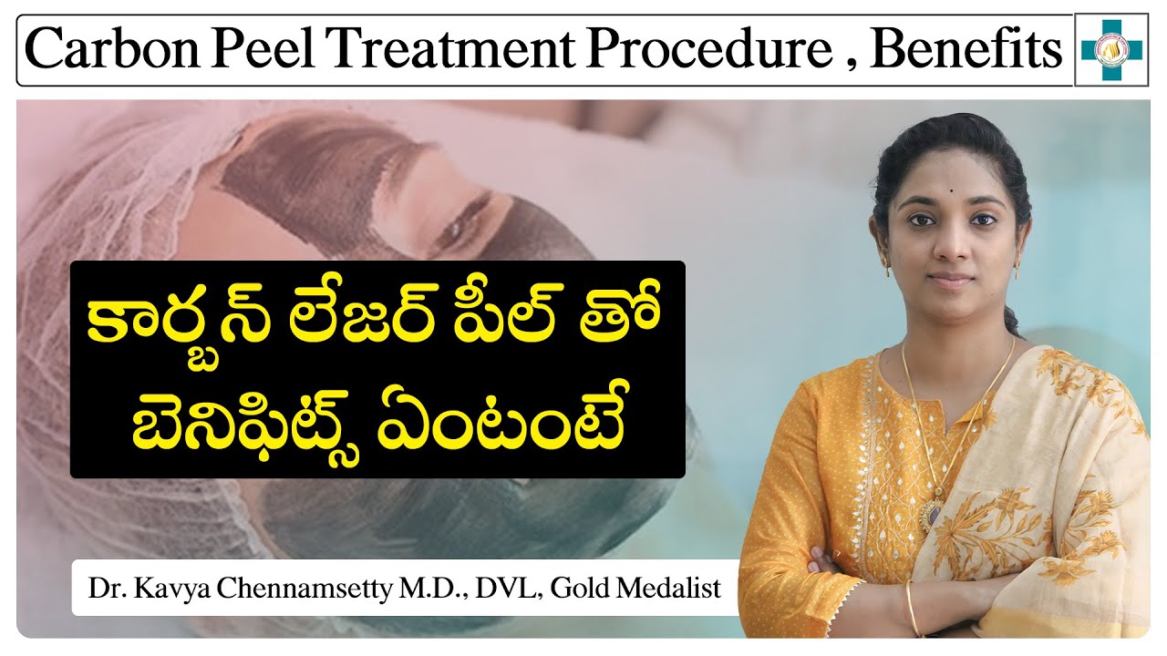 Carbon Peeling Treatment Procedure , Benefits || కార్బన్ లేజర్ పీల్ తో బెనిఫిట్స్ || in Telugu