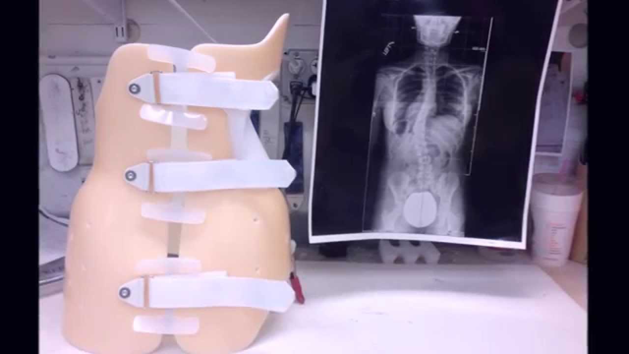 How is it made? Scoliosis braces!