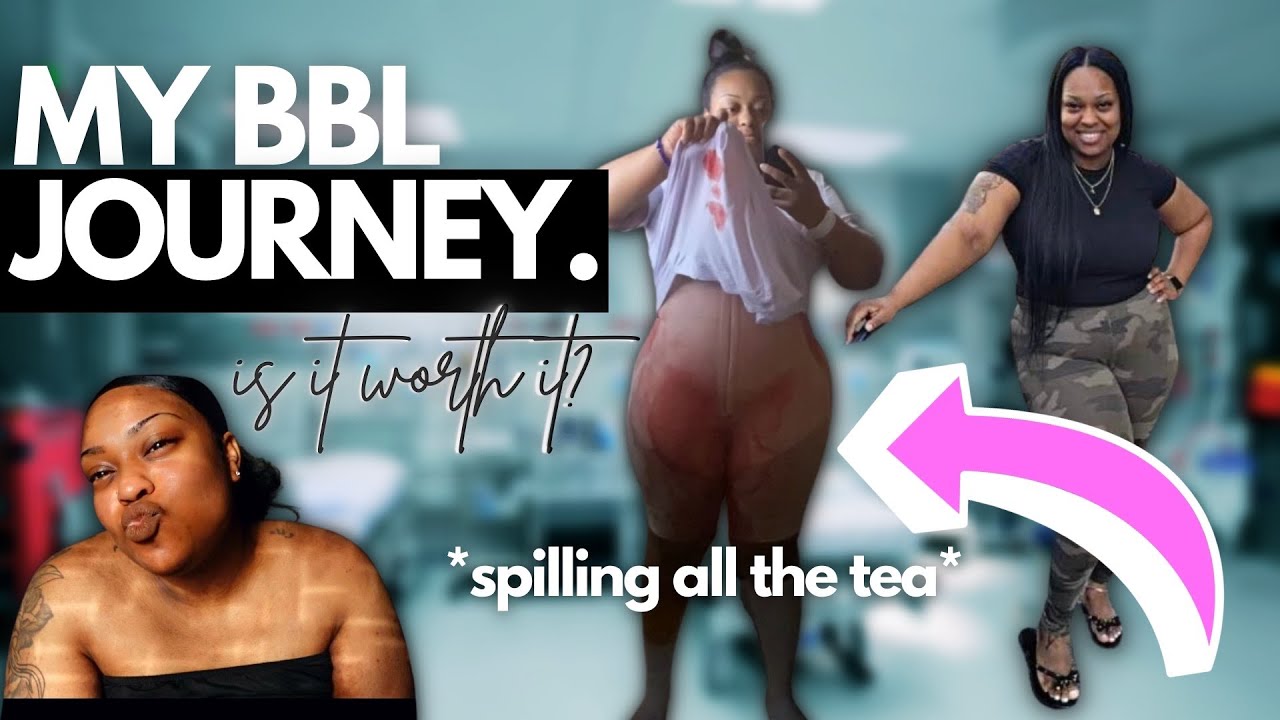 BBL Journey | Miami Life Plastic surgery | do I regret it?