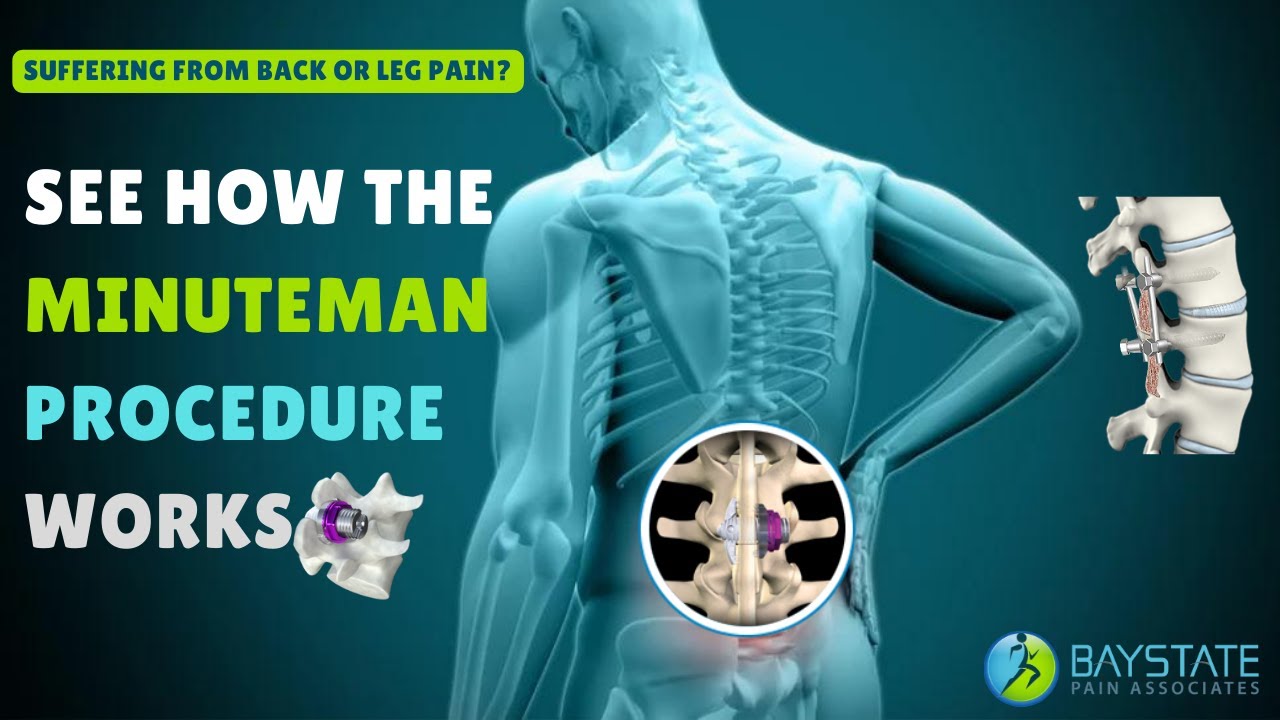 The Minuteman® G5 MIS Fusion Plate for Minimally Invasive Spinal Fusionntitled design