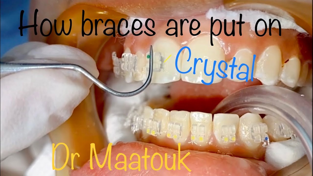 How braces are put on. Crystal braces. كيفية تركيب تقويم الأسنان. تقويم الكريستال الثابت