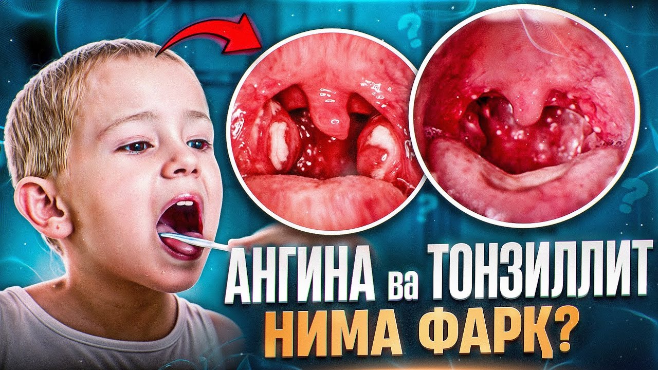 Angina yoki tonzillit. Nima farqi bor? | Doktor Gulbahor