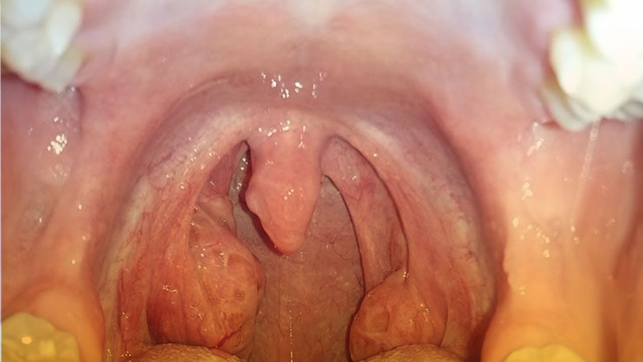 Amígdalas y adenoides
