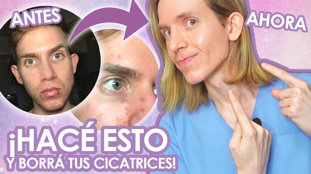 COMO BORRÉ MIS CICATRICES DE ACNE - Recomendaciones de un dermatólogo - Simon Scarano