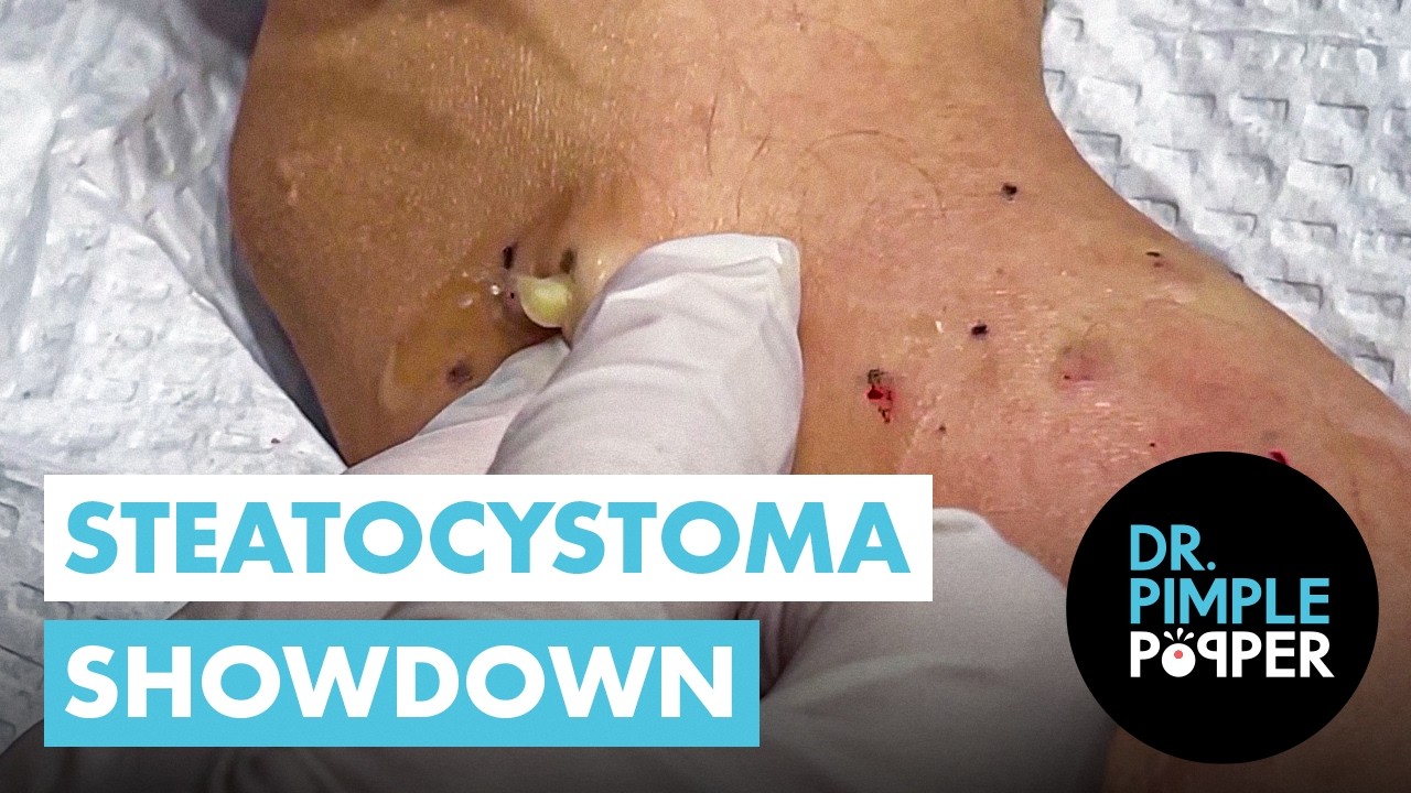 Steatocystoma Showdown &mdash; Which One Pops Best?