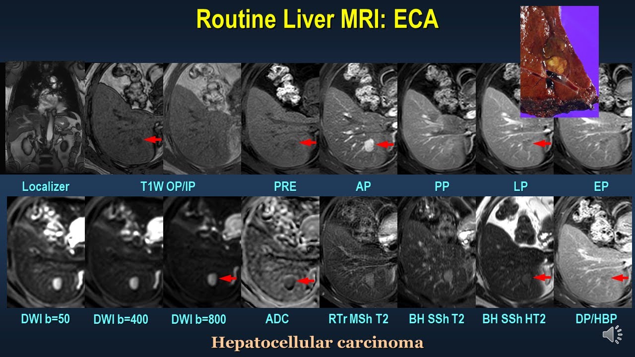 Imaging Techniques of Liver MRI