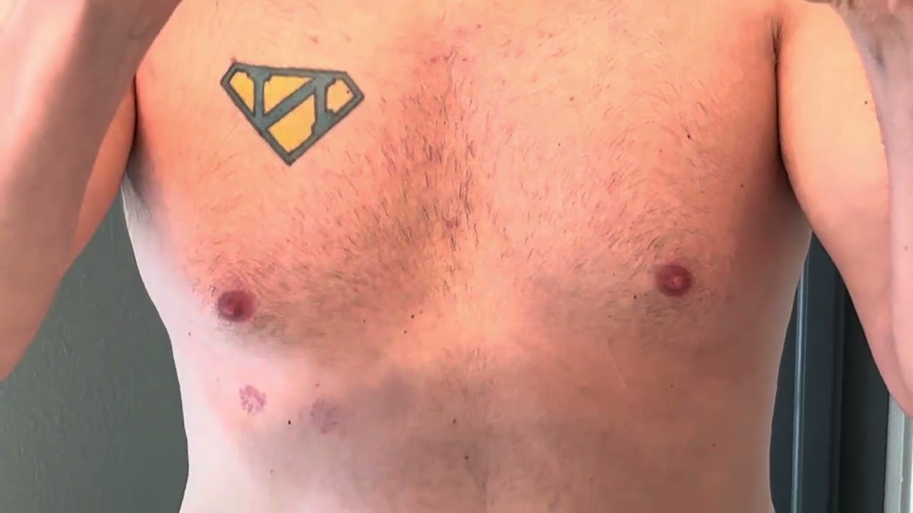 Skin reaction ~ 2 week follow up-  medical adhesive from EKG halter monitor 