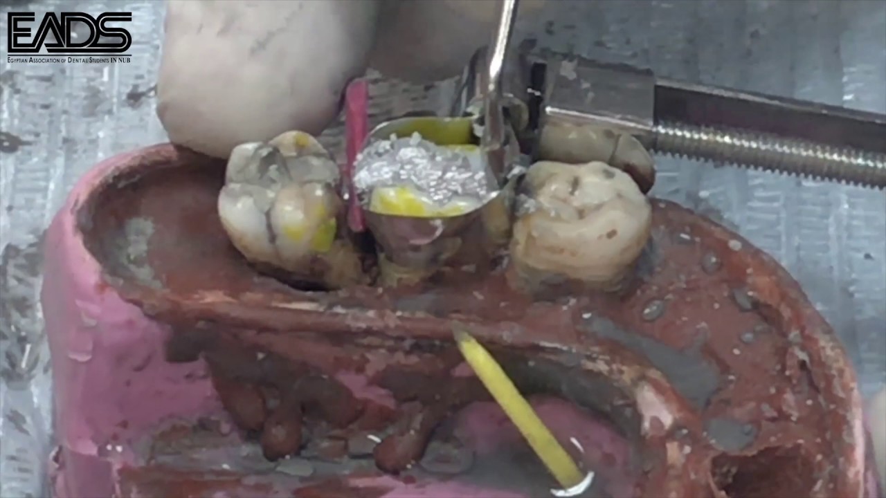 Amalgam class2 Dr/Mohamed abdelmoaty #EADS
