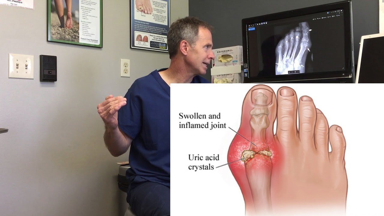 Gout &ndash; Symptoms and Treatment Options Part 1