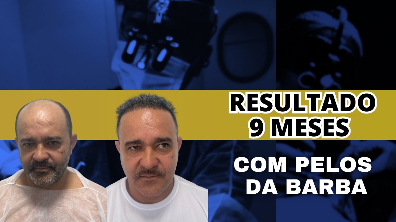 Ele tinha calvície avançada (grau 6)  Olha o cabelo 9 meses depois 😳#transplantecapilar
