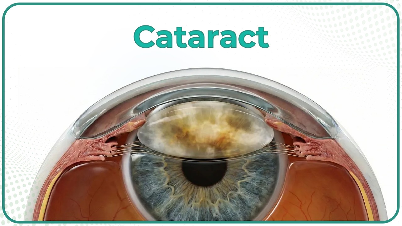 Cataract Animation : Types , Clinical features , Diagnosis, Treatment , Amblyopia , Complications