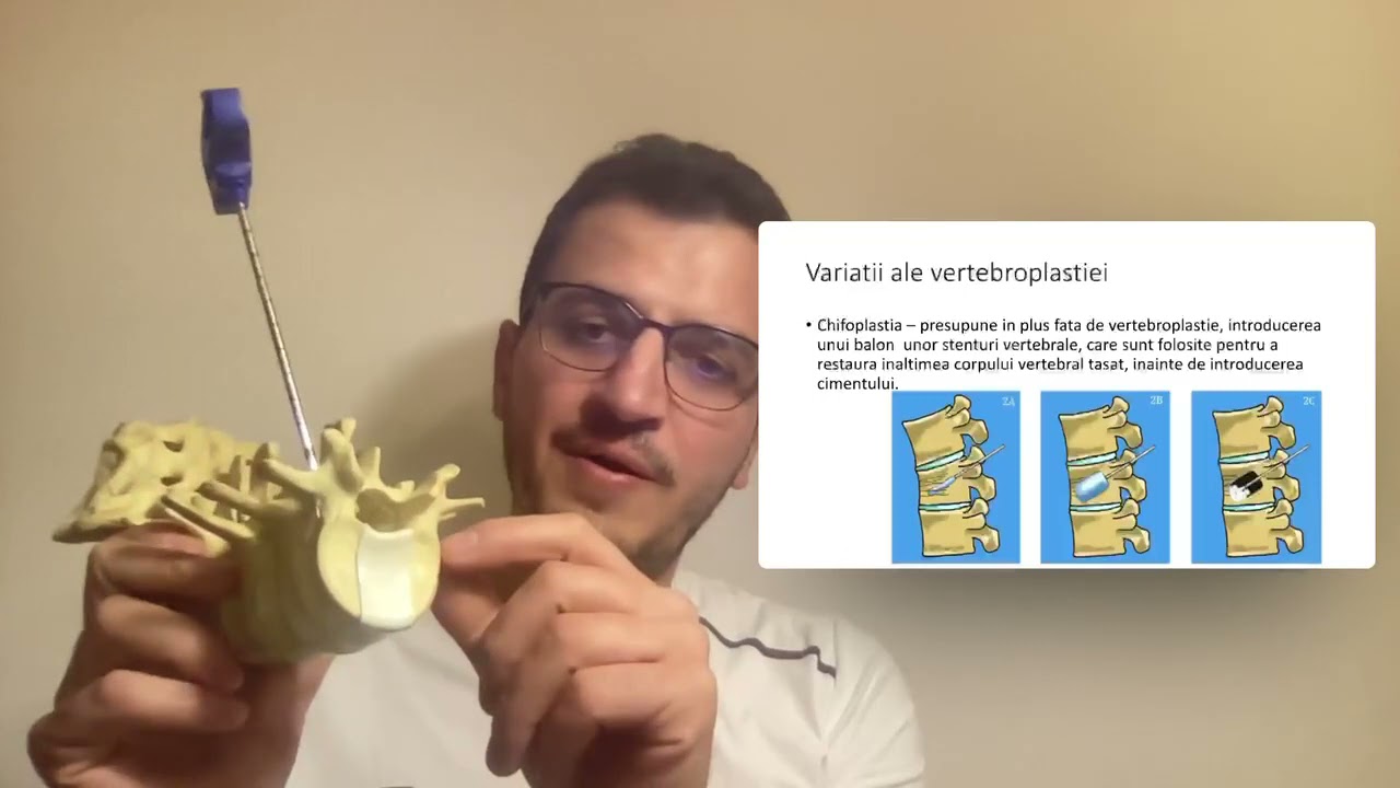 Vertebroplastia - ce este, cum se face, care sunt beneficiile si posibile complicatii.