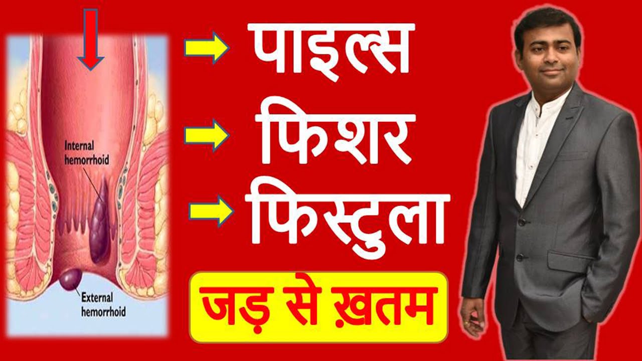 Piles, Fissure and Fistula I पाइल्स फिस्सुरे और फिस्टुला जड़ से ख़तम #piles #fissure #homeopathy