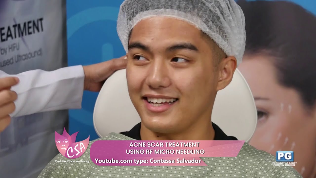 ACNE SCAR TREATMENT  USING RF MICRO NEEDLING