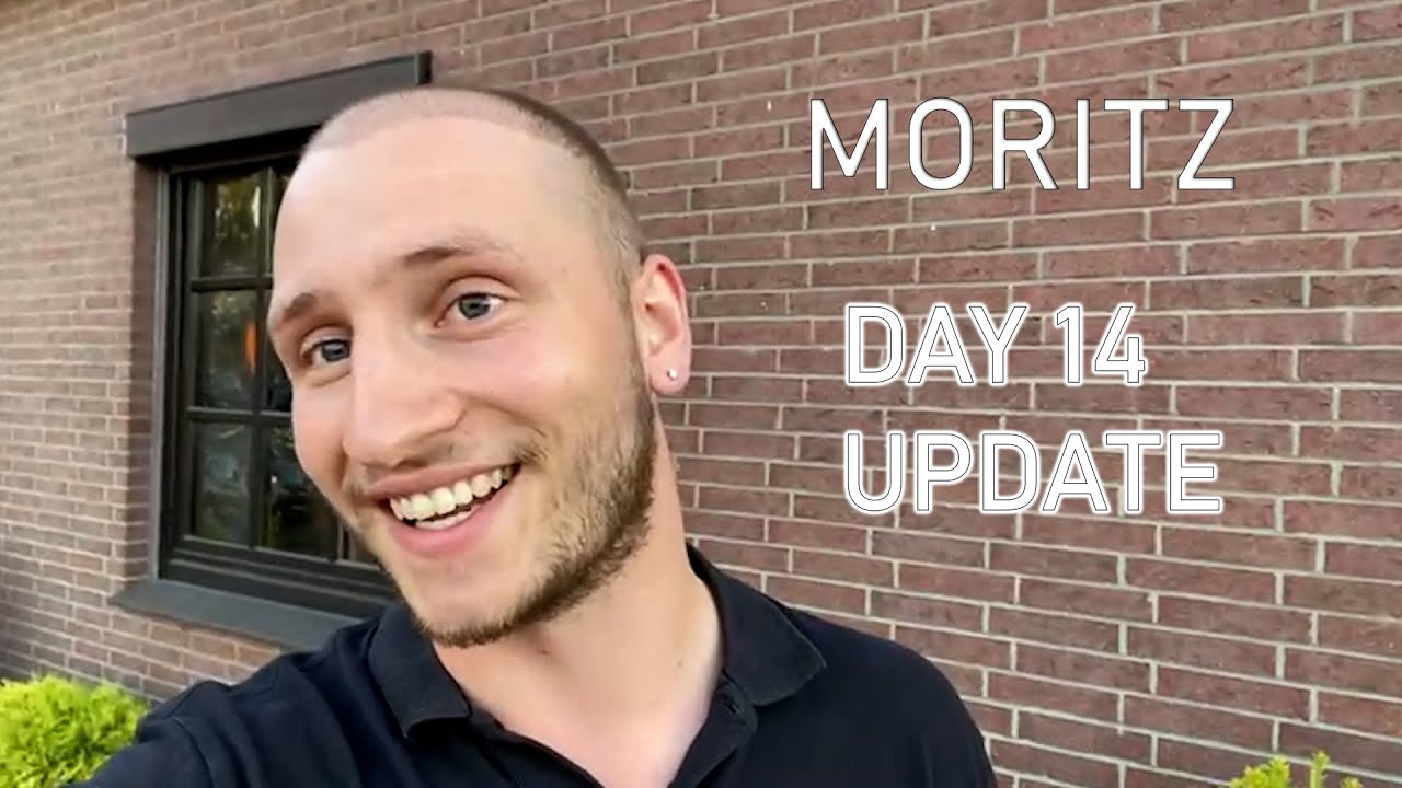Moritz's Hair Transplant Journey in Istanbul with Dr Balwi and Elithair + Day 14 Update.