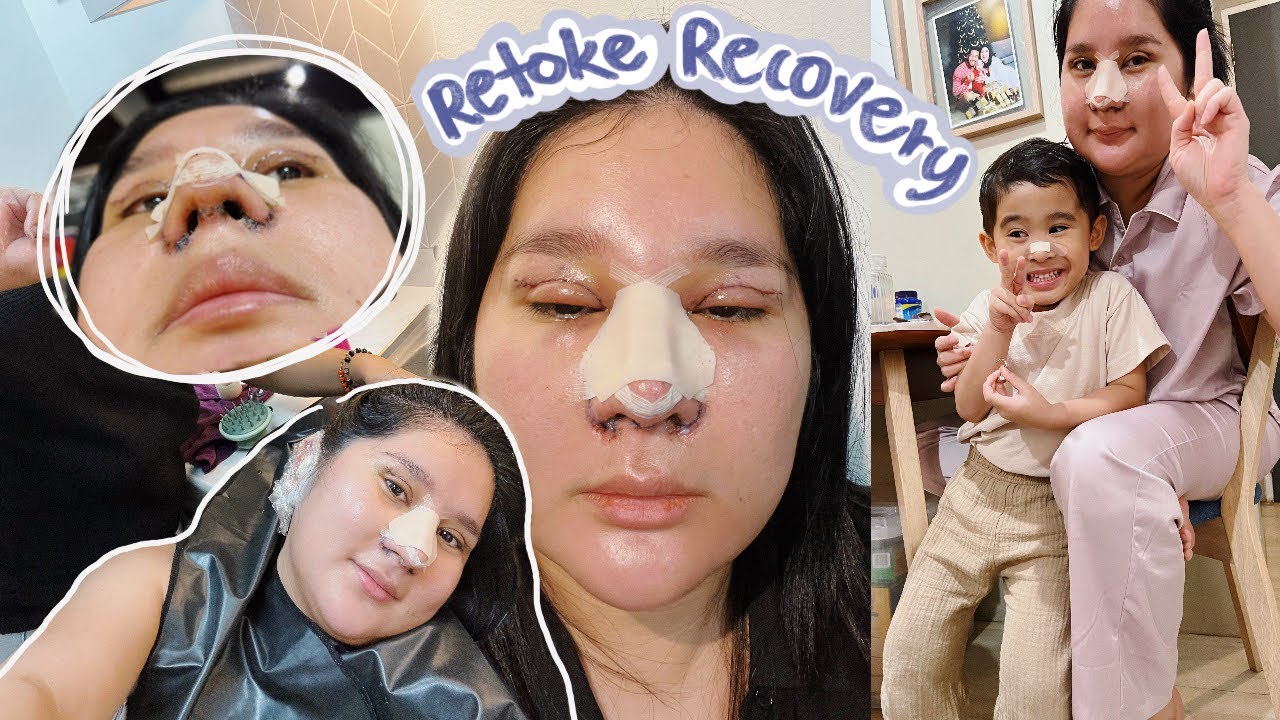 Grabe ang MAGA ng MUKHA! RECOVERY UPDATE ng NOSE + EYELID SURGERY |  Kris Lumagui