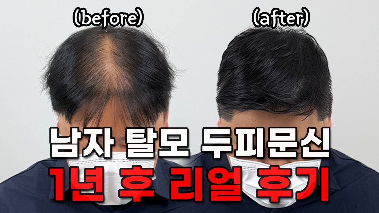 남자 탈모 두피문신, 1년 후 다시 만나서 들은 찐 후기