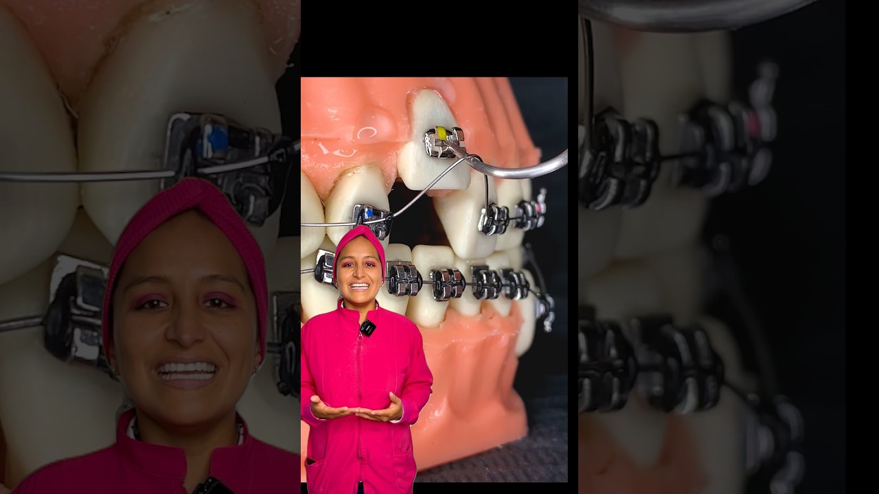 Con un tratamiento de Brackets cualquier Diente se puede Alinear. #brackets #dentista #ortodoncia