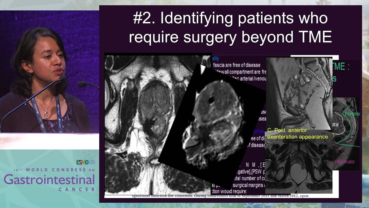 MRI in rectal cancer staging is mandatory