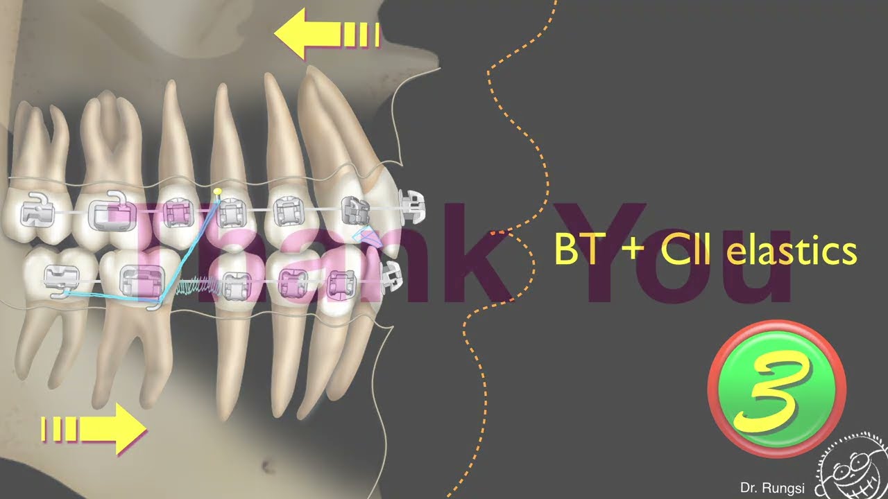 Clinical considerations for Bite turbos(BT)｜【Chris Chang Ortho】CC486
