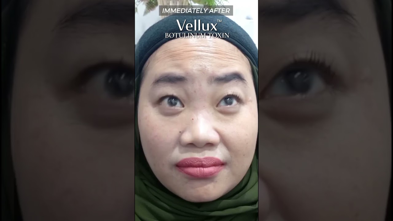 [Vellux] Premium botulinum toxin