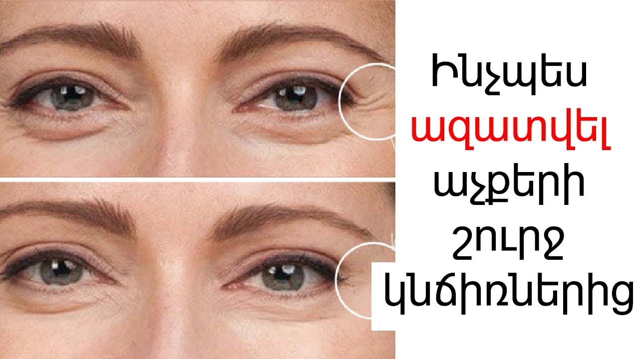 Աչքերի շուրջ կնճիռներից ազատվելու 3 հեշտ բաղադրատոմսեր :