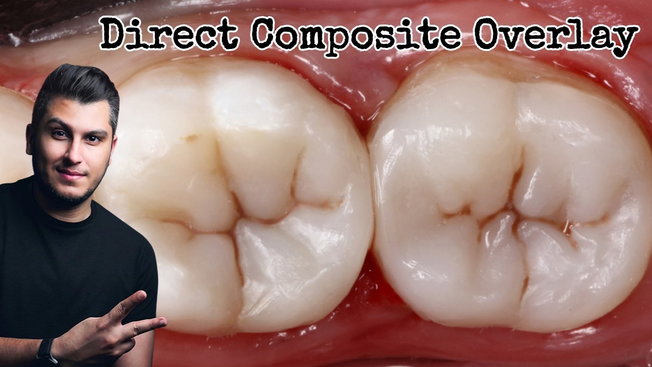 A step by step to direct composite overlay