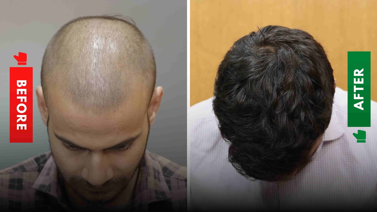 90% Men Don't Know How to Stop Baldness Successfully | 5 Natural Hair Loss Treatment by RQC