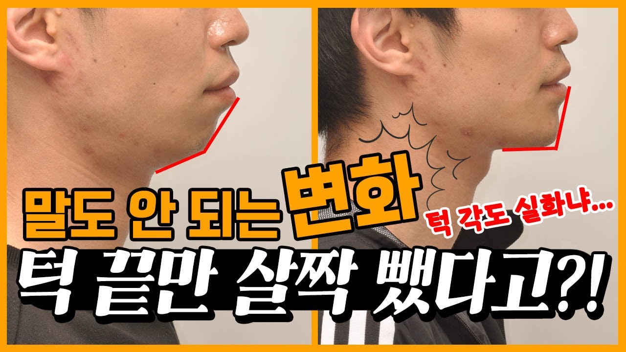 양악수술 없이 간단하게 무턱 해결하는 방법!!
