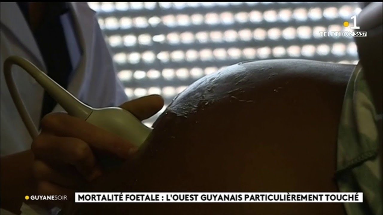 Mortalit&eacute; foetale : l'Ouest guyanais particuli&egrave;rement touch&eacute;