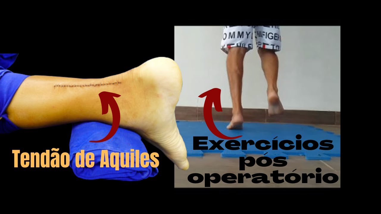 (Passo - a - passo): Exercícios pós operatório para o tendão de Aquiles.