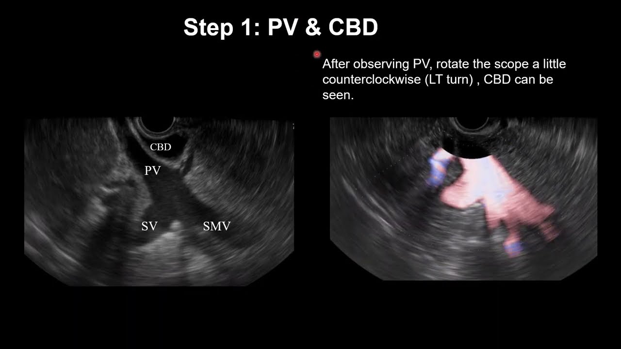 Normal linear EUS for biliary and pancreatic system; transduodenal view