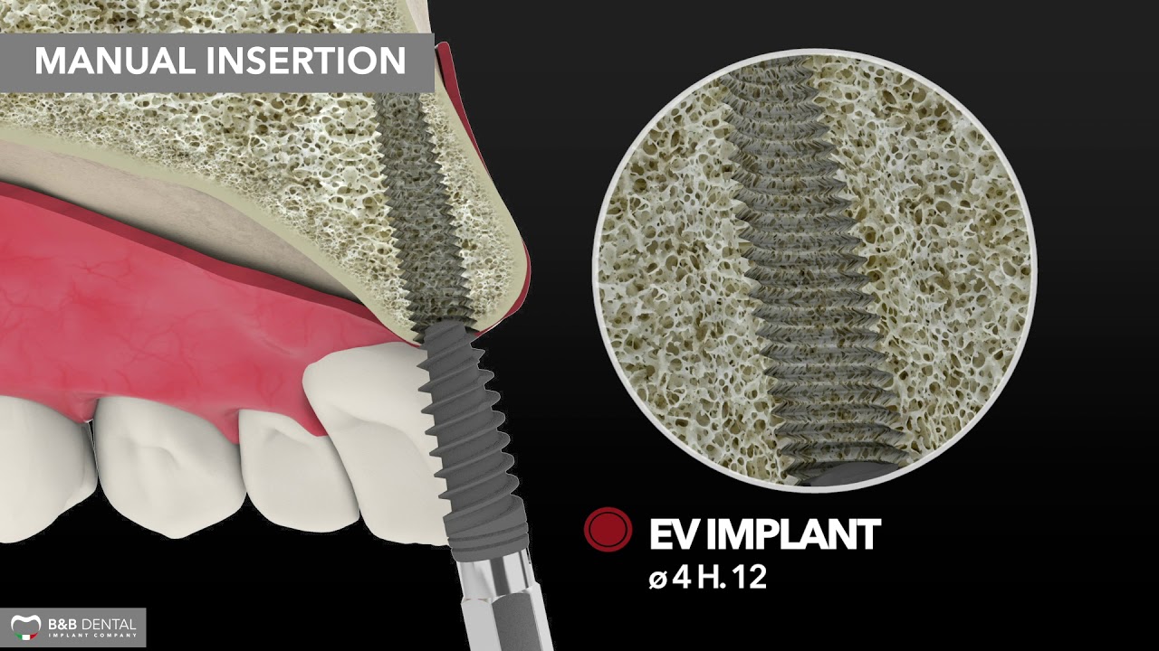 B&B Dental | Compactor expander protocol - D3-D4 bone - EV implant line