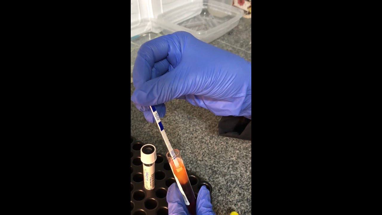 Beta-HCG Qualitativo (Exame de Gravidez) - Como &eacute; Realizado? (An&aacute;lises Cl&iacute;nicas)