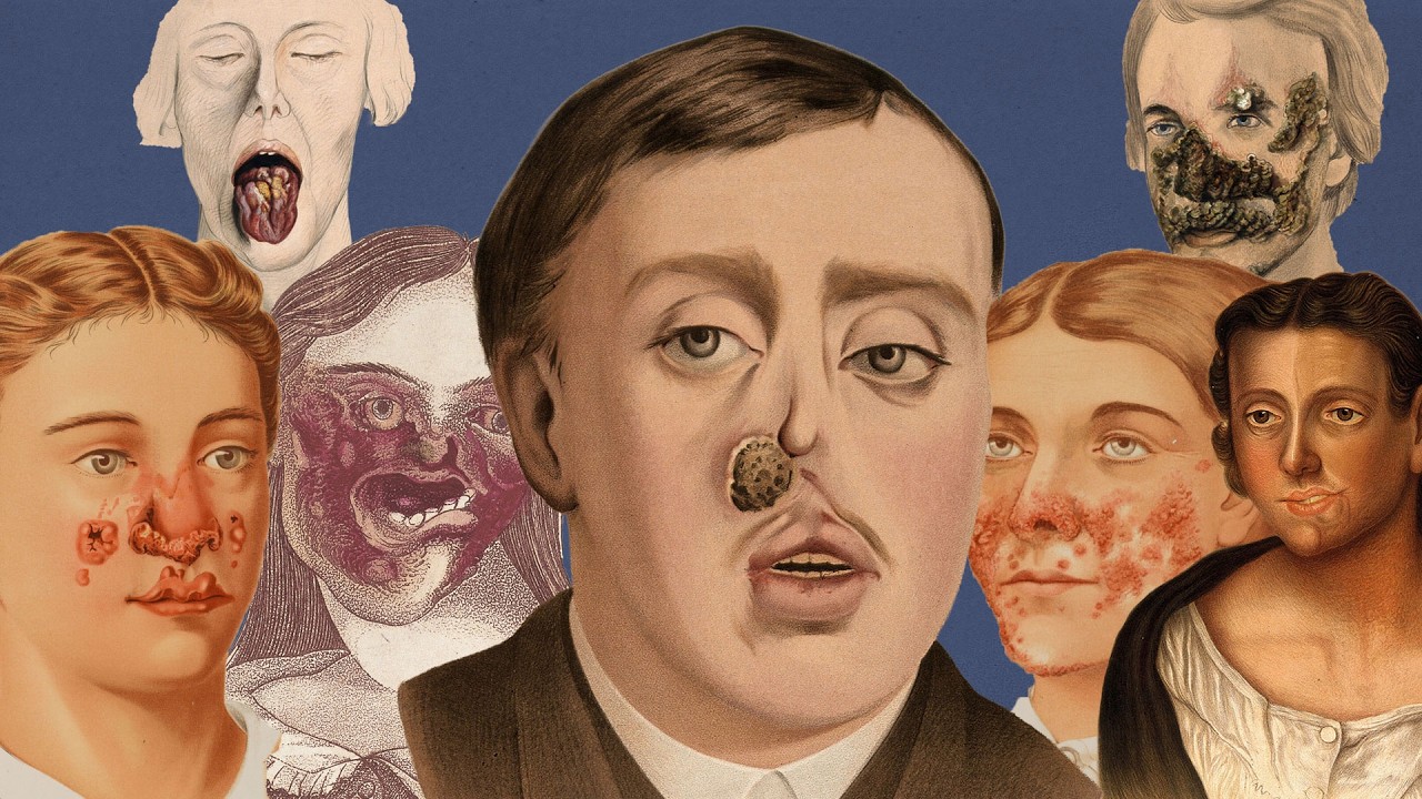 Syphilis Is Evolving Like Never Before.. In Michigan