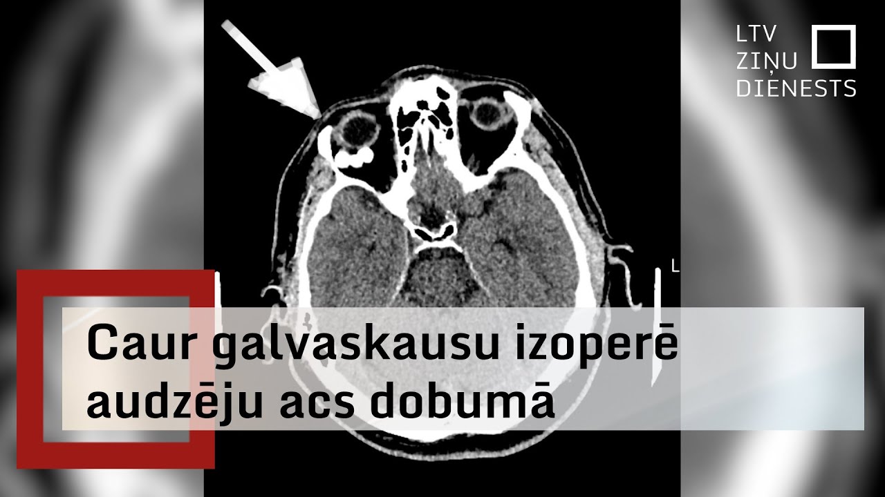 Stradiņa slimnīcā veic unikālu acs operāciju